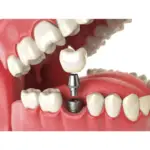 dental implants