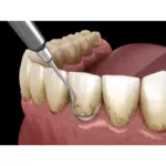 Periodontal Treatments