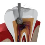 Root Canal Treatment