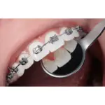 Orthodontic Treatments